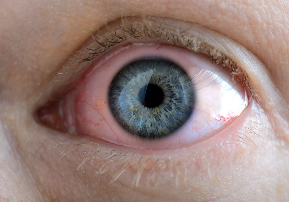 Trockene Augen sind schmerzhaft und sollten behandelt werden