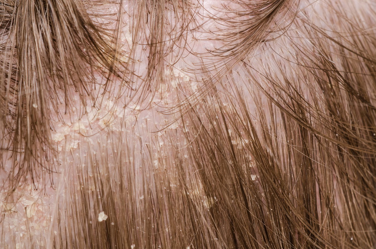 Gegen Schuppen im Haar können Sie erfolgreich vorgehen