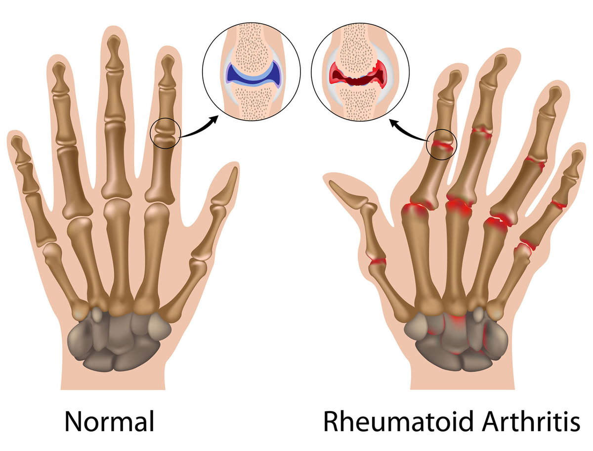 Unterschied Arthrose und rheumatoide Arthritis