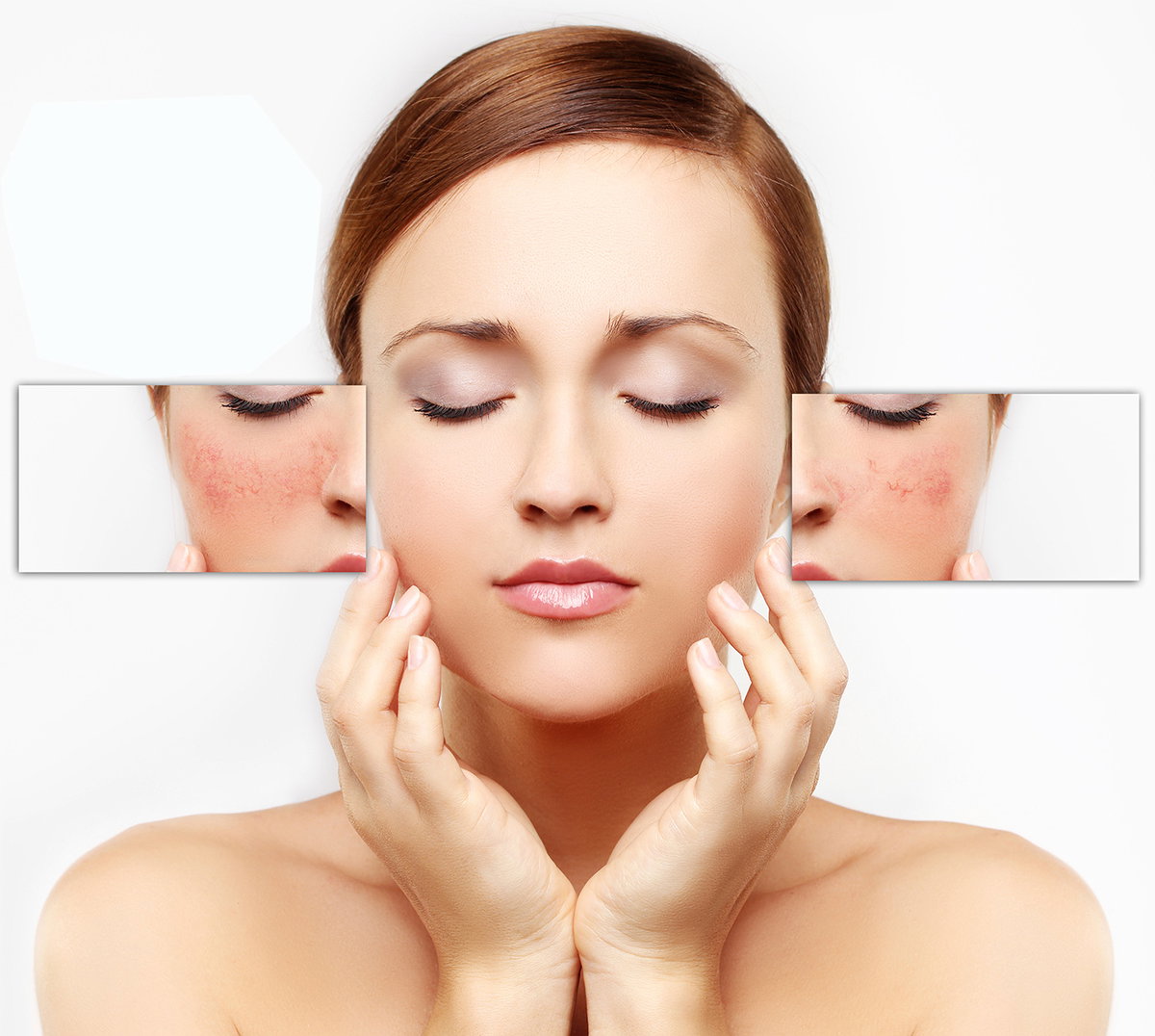 Rosacea: Was sind die Ursachen, Symptome und Behandlungsmöglichkeiten?
