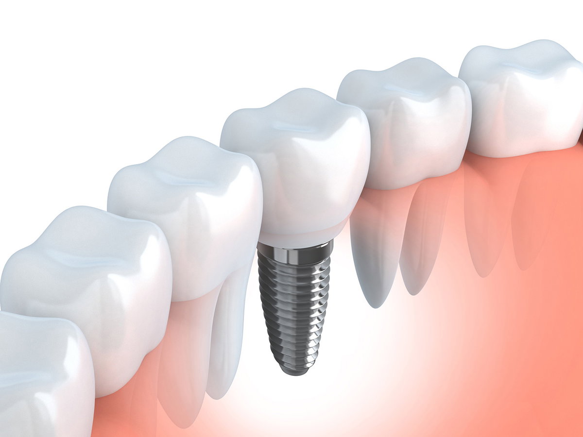 Beim Implantat ersetzt eine Schraube die Zahnwurzel. Sie besteht zum Beispiel aus Titan.