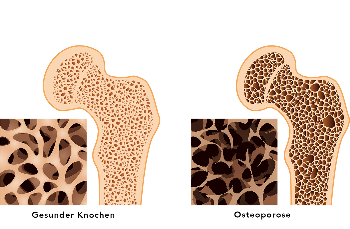 Bei der Osteoporose geht mehr Knochensubstanz verloren als aufgebaut wird. Die kleinen Knochenbälkchen, die für die Tragfähigkeit des Knochens sorgen, können brechen. Das macht die Knochen insgesamt mürbe.