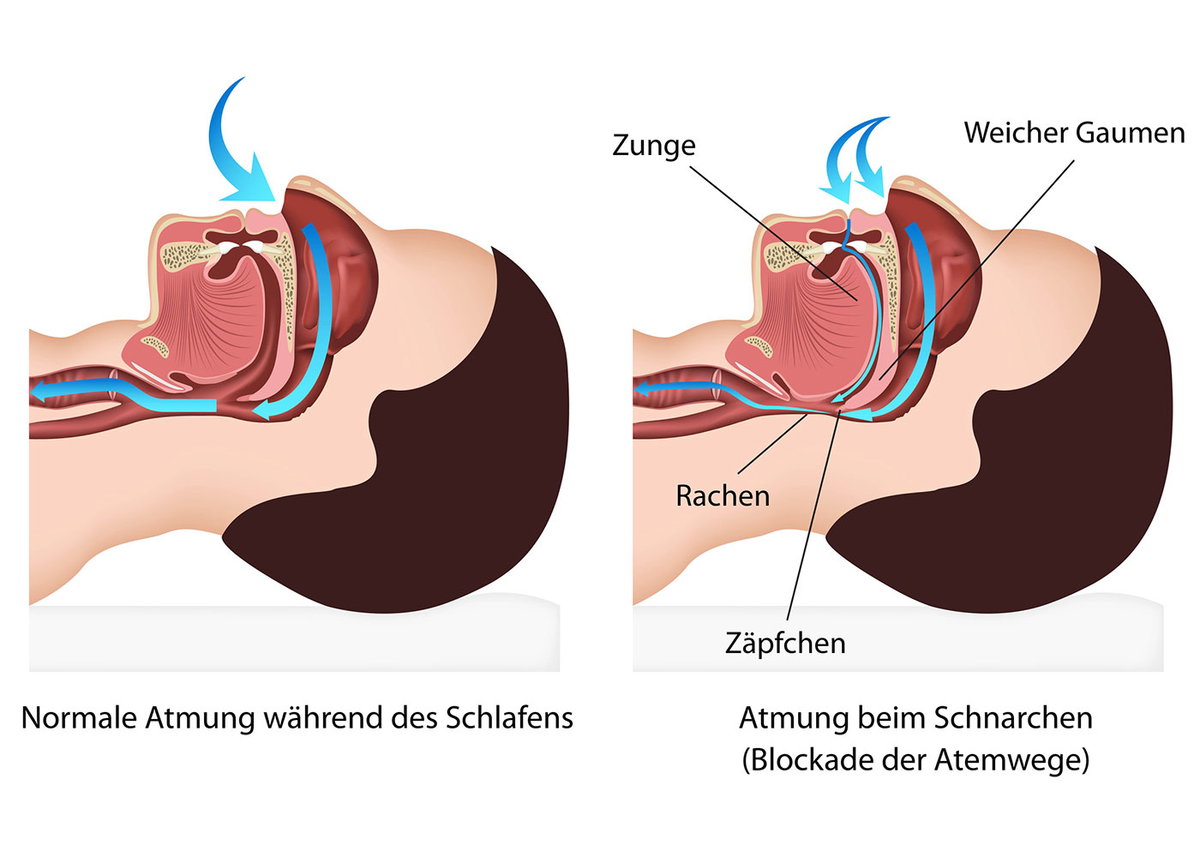 Anatomische Grafik von einem normal atmenden Menschen neben einem schnarchenden Menschen