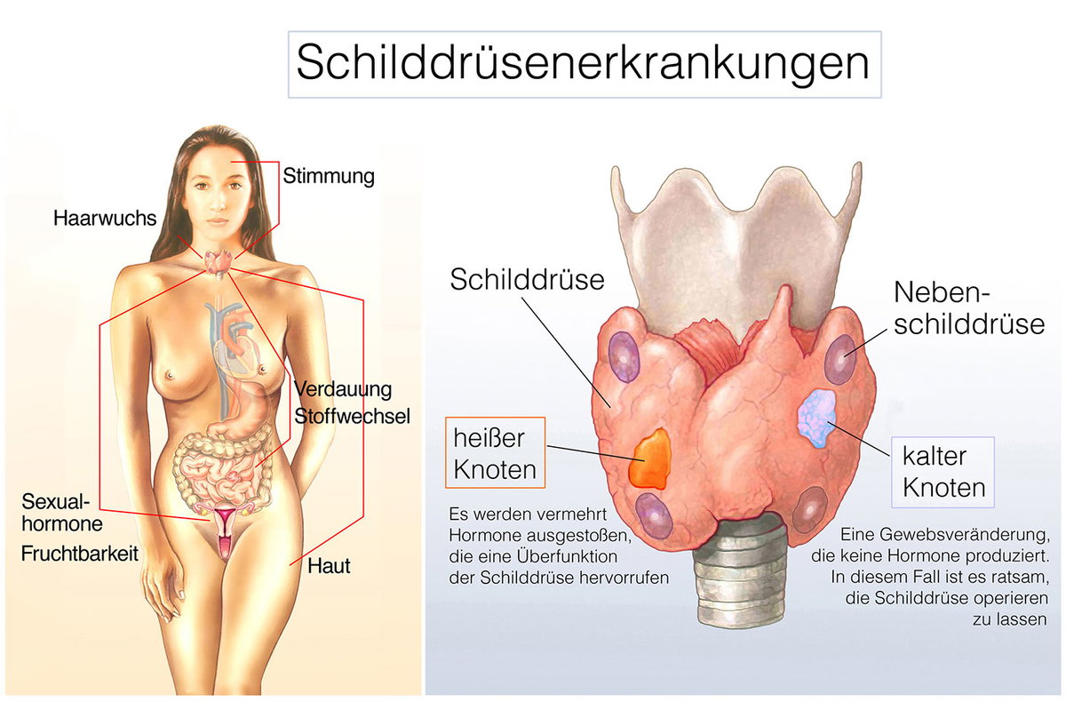 Grafik eines weiblichen Körpers und einer erkrankten Schilddrüse