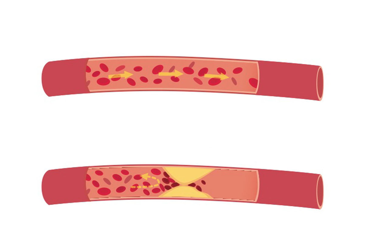 Das Cholesterin wird zu den Organen transportiert. Unten: In den Adern lagert sich das LDL ab.