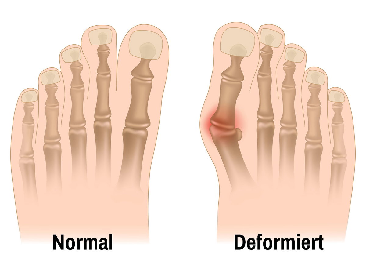 Grafik von normalem Fuß und Fuß mit Hallux valgus