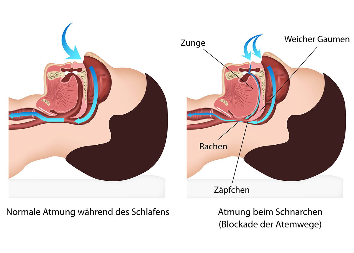 Im Schlaf entspannt sich die Muskulatur im Rachen, Gaumen und Zunge erschlaffen und können den Rachen blockieren. Die Atemluft kann dann nicht mehr frei zirkulieren, Gaumensegel und -zäpfchen flattern geräuschvoll bei jedem Atemzug.