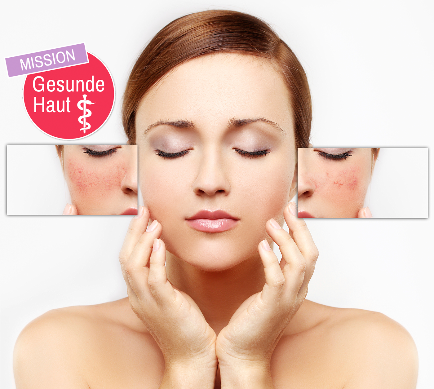 Porzellanteint trotz Rosacea: 4 Pflegetipps für ebenmäßige Haut