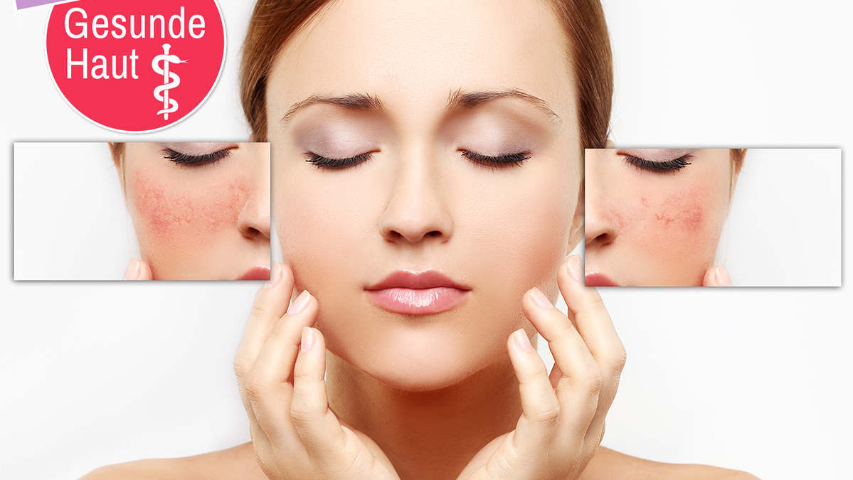Rosacea'ya rağmen porselen ten: Eşit cilt tonu için 4 cilt bakımı ipucu