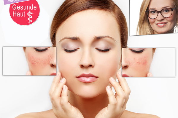 Conseil d'expert : que faire en cas de rosacée ?