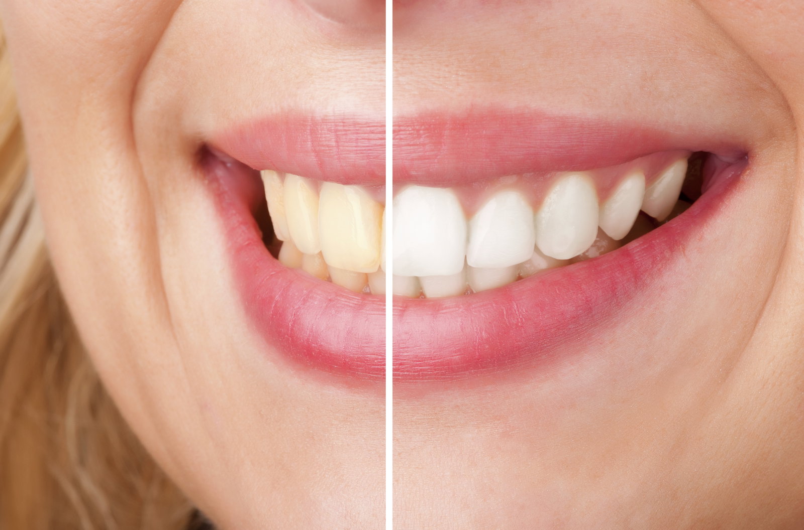 Décoloration des dents : 4 raisons pour lesquelles vos dents ne sont pas plus blanches