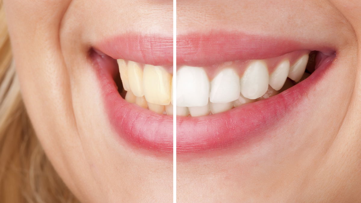 Décoloration des dents : 4 raisons pour lesquelles vos dents ne sont pas plus blanches