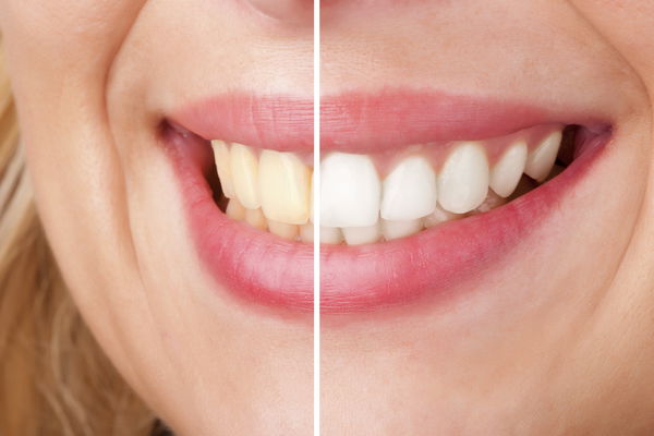 Décoloration des dents : 4 raisons pour lesquelles vos dents ne sont pas plus blanches