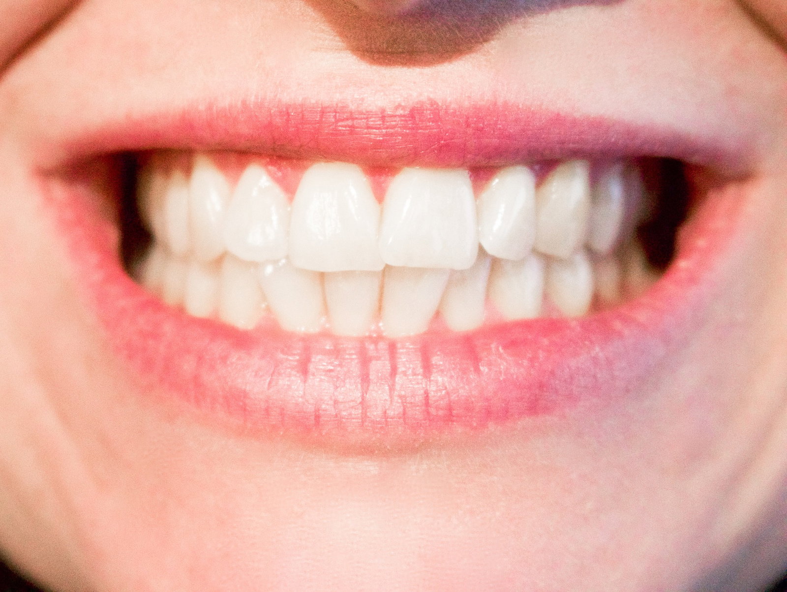 Making teeth brighter: Are my teeth suitable for bleaching?