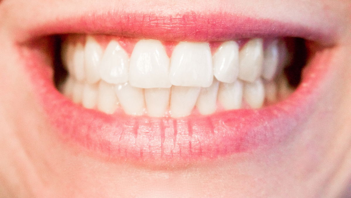 Making teeth brighter: Are my teeth suitable for bleaching?