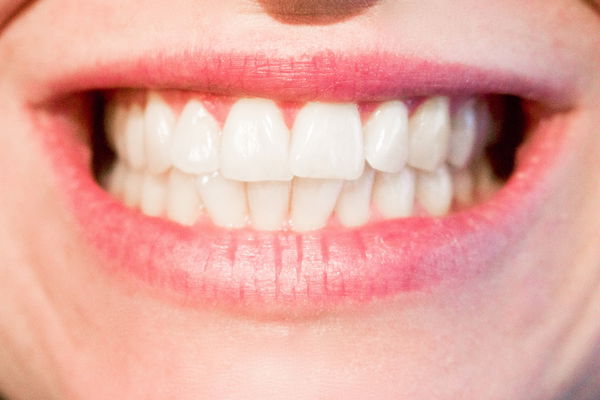 Rendre les dents plus claires : Mes dents se prêtent-elles au blanchiment ?