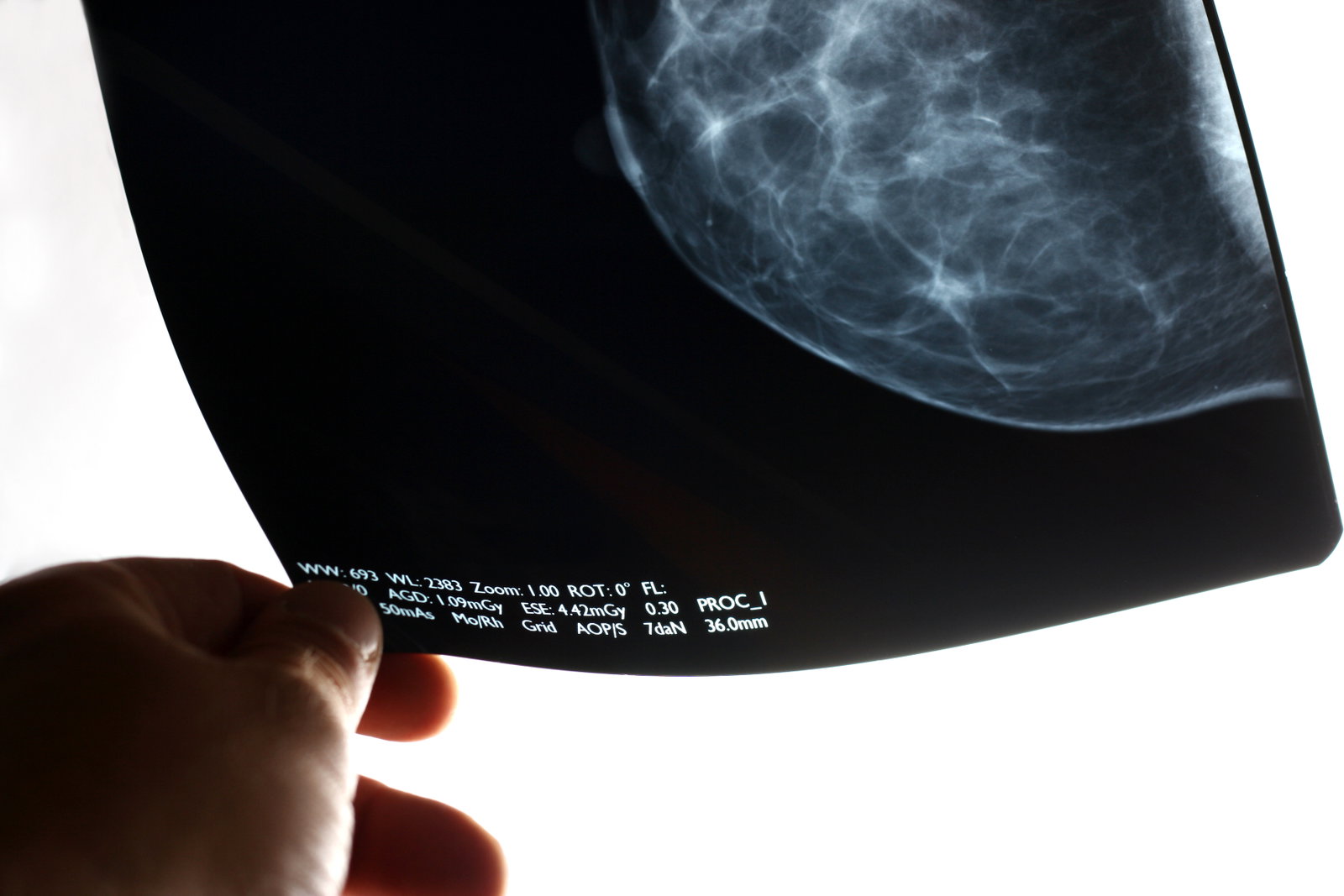 Digital mammography: When and for whom is the new method worthwhile?