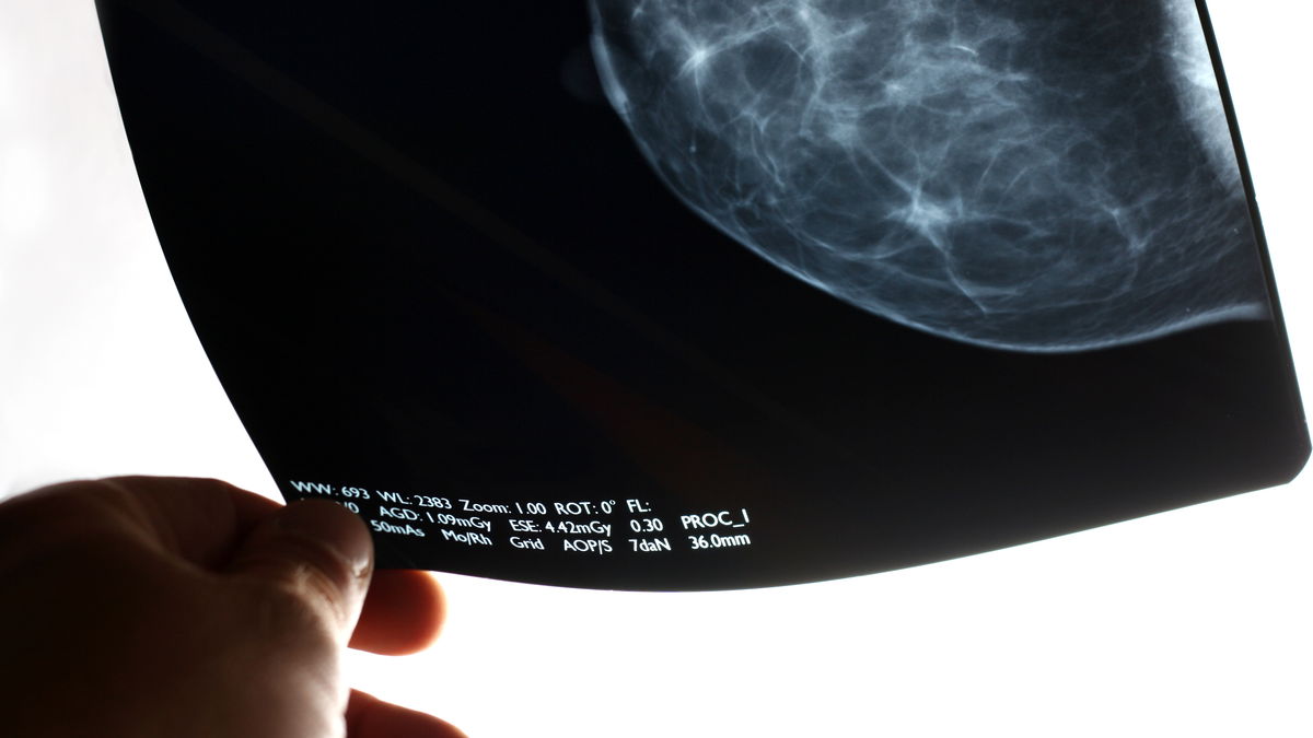 Digital mammography: When and for whom is the new method worthwhile?