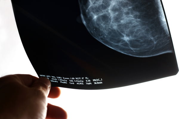 Digital mammography: When and for whom is the new method worthwhile?