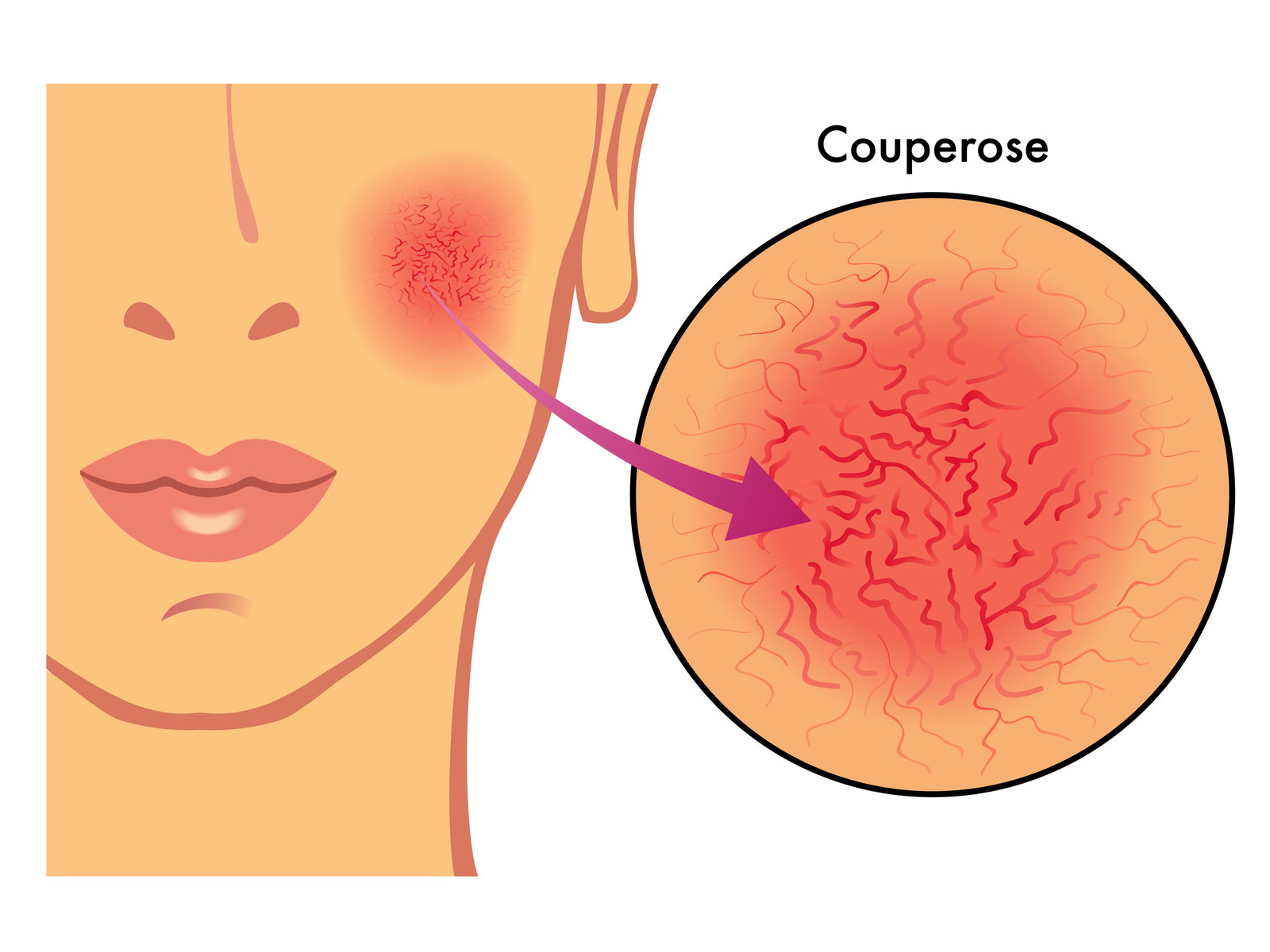 Yüzümde kırmızı damarlar: rosacea mı var?