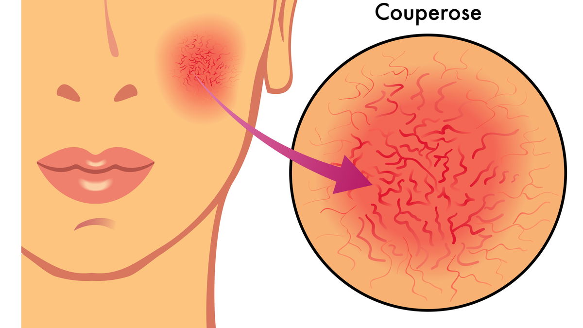 Yüzümde kırmızı damarlar: rosacea mı var?