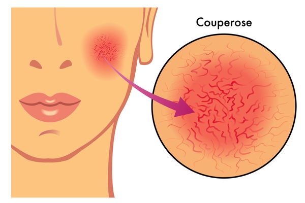 Yüzümde kırmızı damarlar: rosacea mı var?