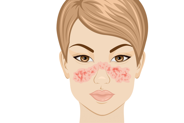 Une défaillance du système immunitaire : qu'est-ce que le lupus ?