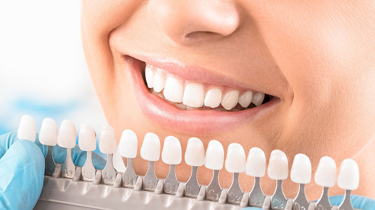 Blanchiment : méthodes, risques & coûts du blanchiment des dents