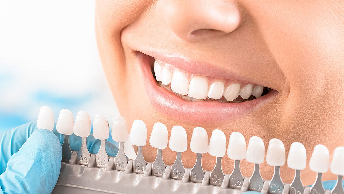 Blanchiment : méthodes, risques & coûts du blanchiment des dents