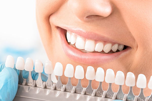 Blanchiment : méthodes, risques & coûts du blanchiment des dents