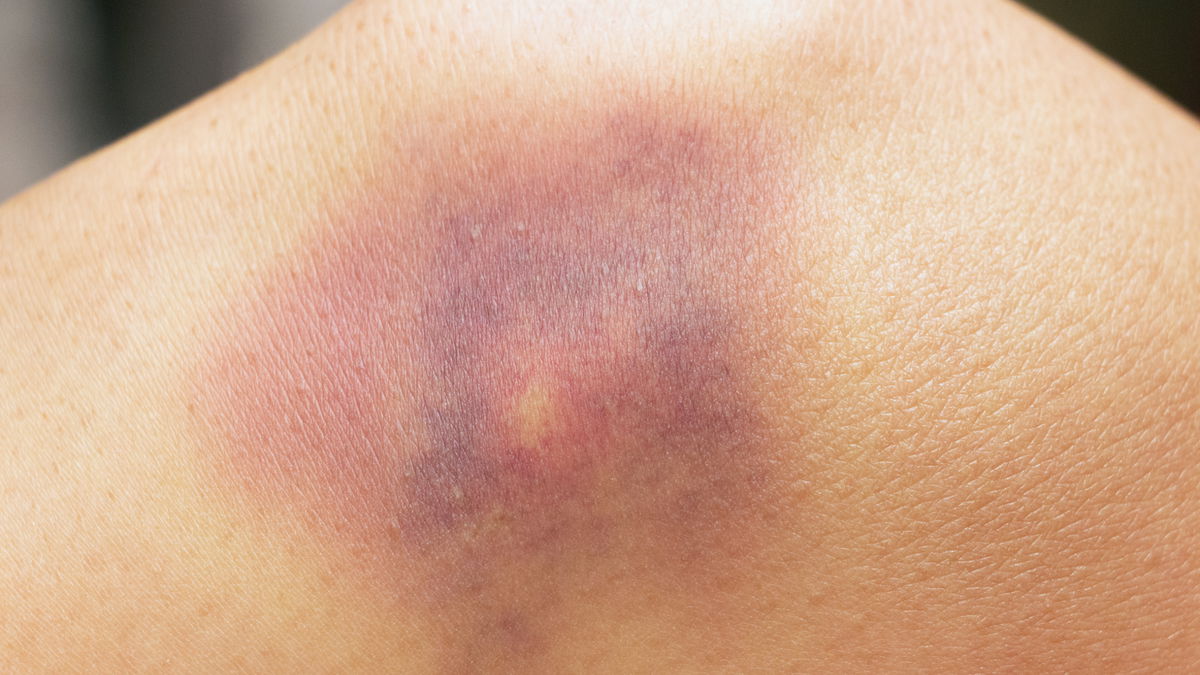 Warum bekommen Frauen eher blaue Flecken als Männer?