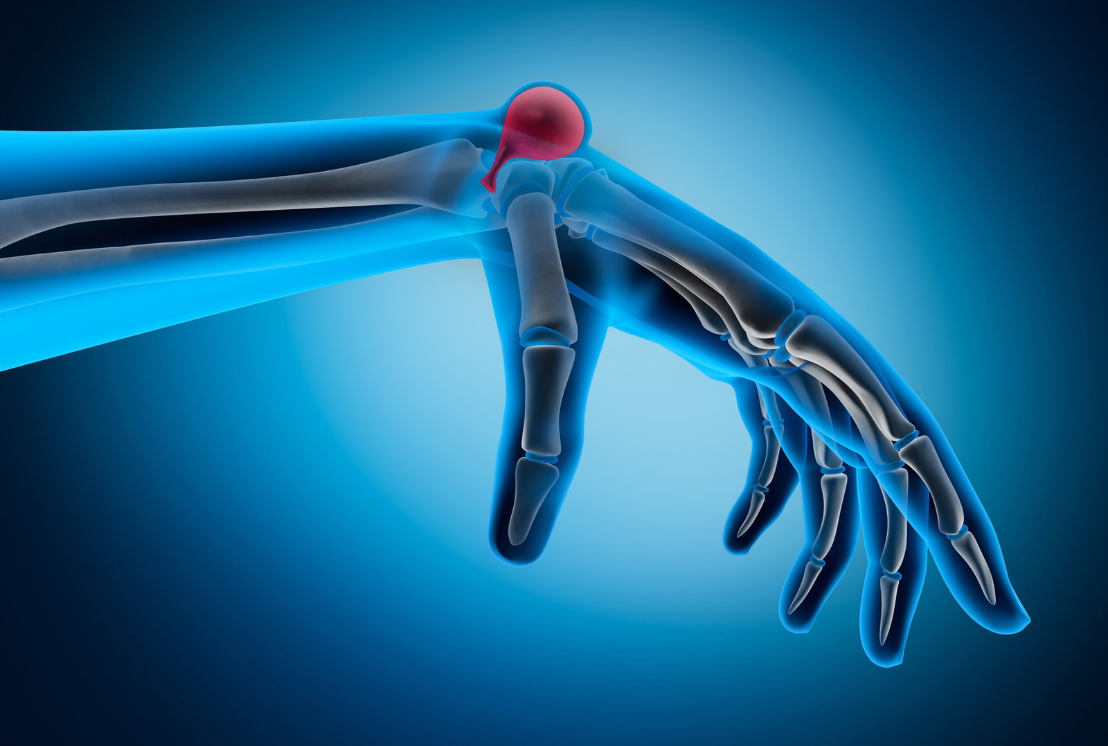Traiter l'hypercubitus : Qu'est-ce qui aide ?