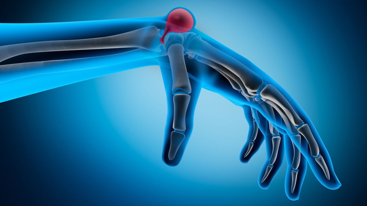 Treating a ganglion: What helps?